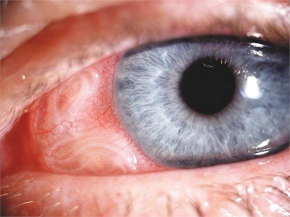 Дирофиляриоз глаз: чем опасен укус комара?