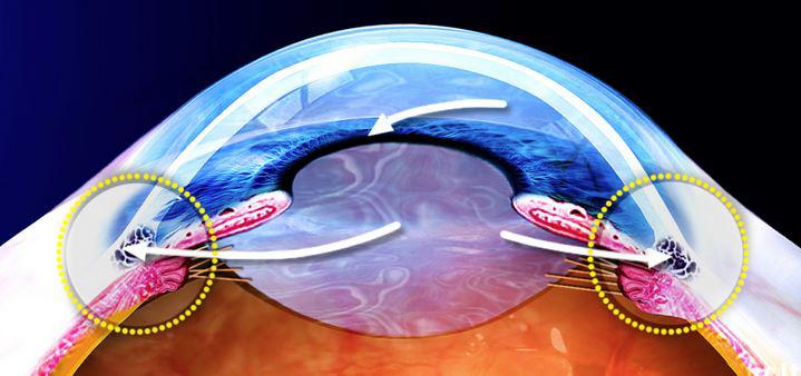 Хирургия глаукомы